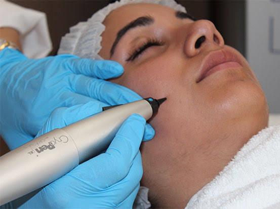 Cryo Pen Applicator